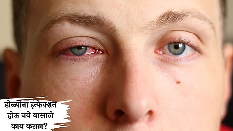 Eye Flu Symptoms