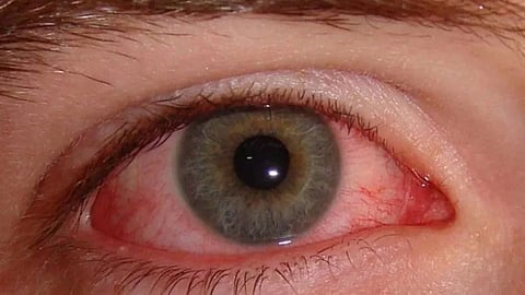 Eye Flu Disease Increased