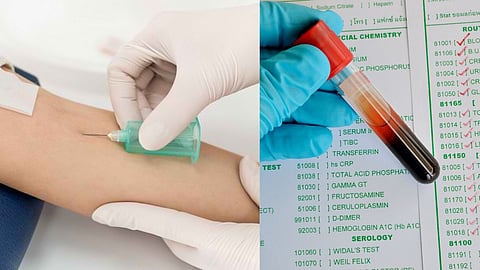 Jaundice Disease