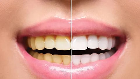 Teeth Cleaning at Home: दातांचा पिवळेपणा दूर करण्यासाठी या घरगुती टिप्सचा उपयोग करा, दात मोत्यासारखे चमकतील