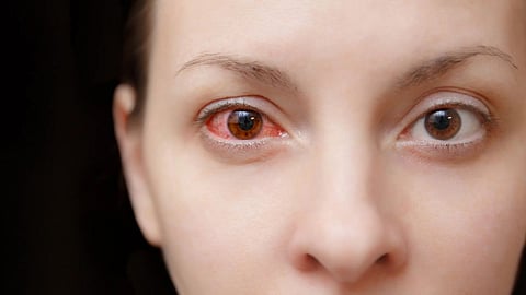 Air Pollution Affects Eye