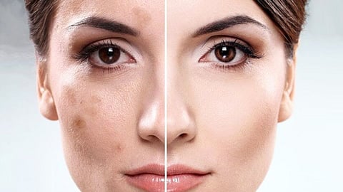 Pimple Home Remedies
