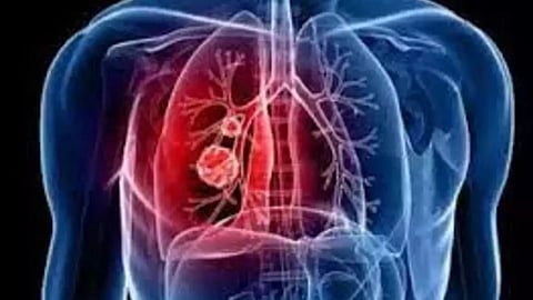 Pneumonia In Pakistan