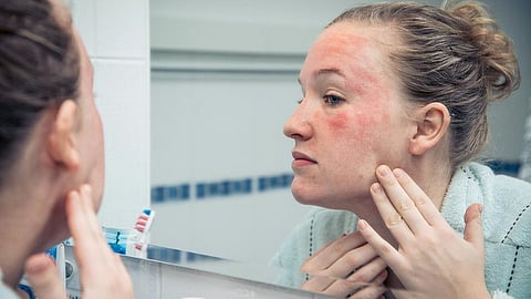 Skin Care Tips, Skin Care After Holi 