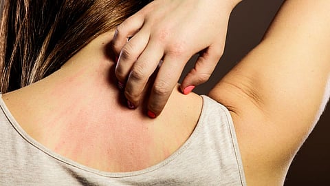 Ayurvedic Home Remedies For Itchy Skin Allergy