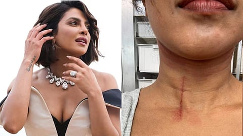 Priyanka Chopra Injured : प्रियांका चोप्राचा चित्रपटाच्या सेटवर अपघात, The Bluff च्या शुटिंगवेळी गळ्यावर गंभीर जखम