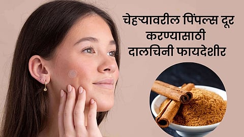 Pimple Free Skin