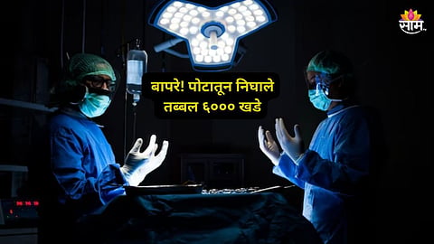 Rajasthan News: OMG! एक, दोन नव्हे, पोटातून निघाले तब्बल ६००० खडे; कर्मचारी मोजून थकले, ऑपरेशन करताना डॉक्टरांना घाम फुटला