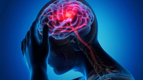 Brain Stroke: ब्रेन स्ट्रोकमुळे देशात 20 मिनिटाला एक बळी? काय आहे व्हायरल मेसेजमागचं सत्य?