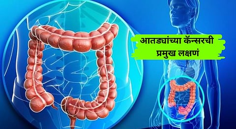 Colon Cancer symptoms
