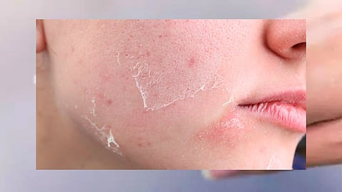 Winter Skin Care 