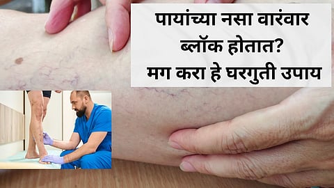 Varicose Vein Home Remedies