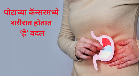 Stomach cancer