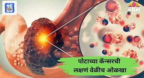 Early Sign Of Stomach Cancer