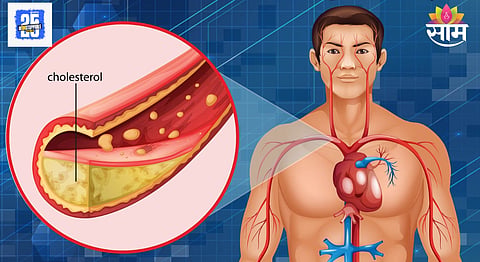 Symptoms of high cholesterol in body