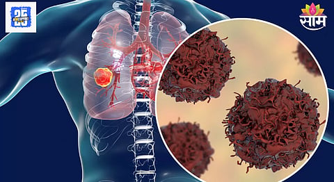 Lung Cancer Symptoms