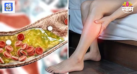 Signs of high bad cholesterol