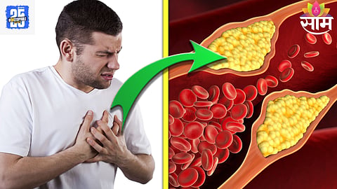 Cholesterol 