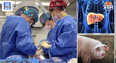 Pig Liver Transplant