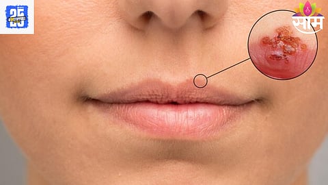 Lips Cancer
