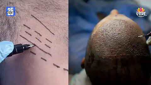 Hair Transplant