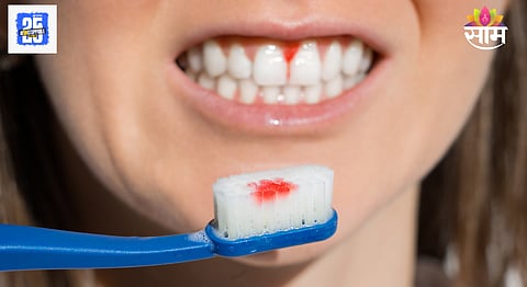 Reason of Bleeding Gums