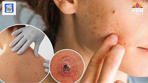 Face pimple cancer 