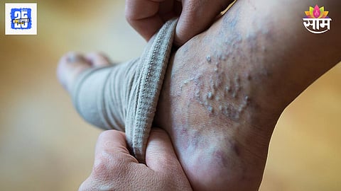 Leg Vein Blockage