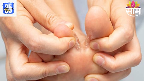 Foot Fungus: पावसाळ्यात 'पायांची बुरशी' कशी टाळायची? बुरशीपासून बचावासाठी उपयुक्त ४ उपाय