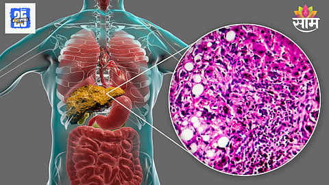 Fatty liver Ayurvedic treatment