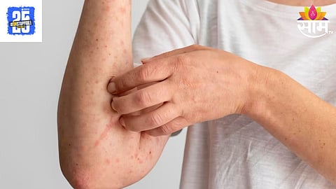 Fungal Infection Cases Buldhana