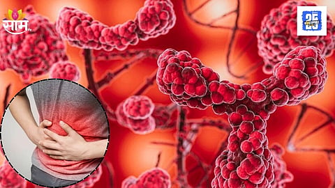 Blood Type Could Be Linked to Stomach Cancer