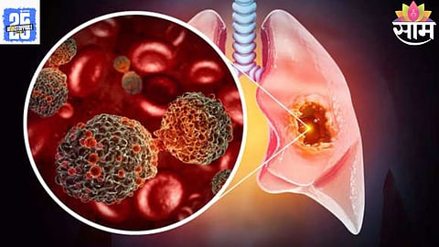 Lung Cancer Symptoms
