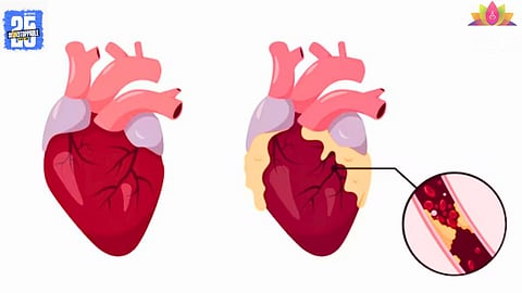 Heart Attack Risk