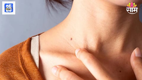 Skin Cancer