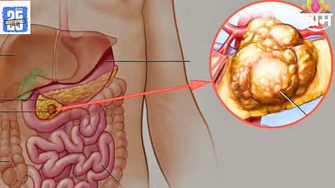 Pancreatic Cancer Symptoms: पॅन्क्रियाटिक कॅन्सरची लक्षणं वेळीच ओळखा अन् तुमचा जीव वाचवा