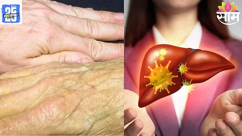 Liver Disease