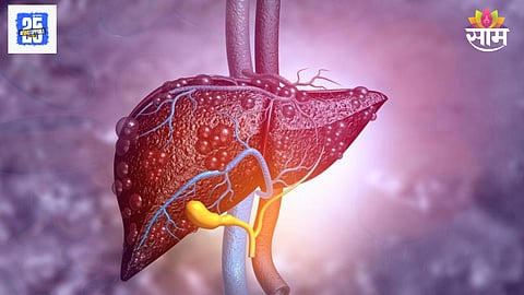 Liver cancer