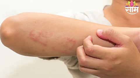 Vitamin deficiency and skin itching