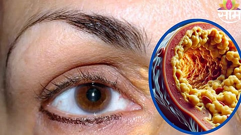 Cholesterol Warning Signs