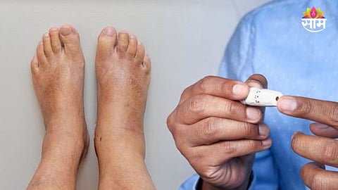 Diabetes Symptoms