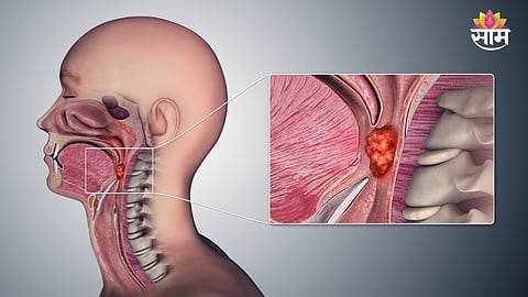 Throat cancer
