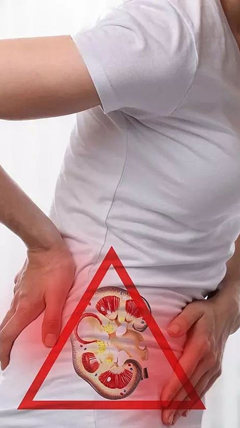 KIDNEY STONE OR BACK PAIN? KNOW THE WARNING SIGNS AND DIFFERENCES