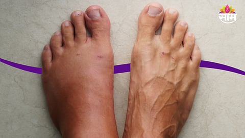 Summer swelling problems: उन्हाळ्यात हात-पाय सुजतायत? डॉक्टरांनी दिला गंभीर आजारांचा धोक्याचा इशारा