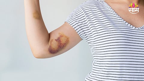 Blue bruises on skin