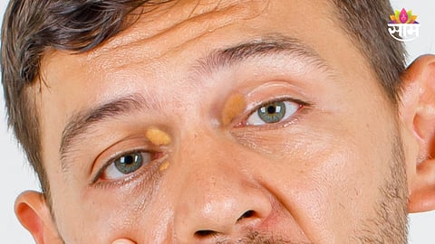 Eye cholesterol deposits