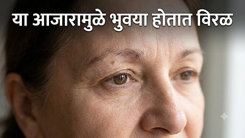 Causes of eyebrow hair loss