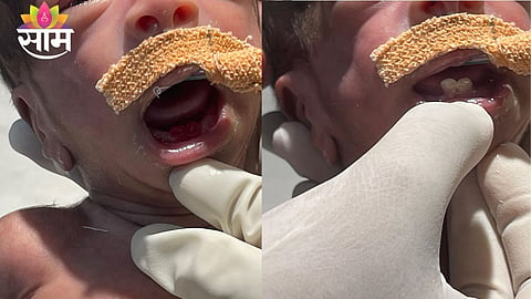 Doctors perform delicate procedure on premature newborn with rare natal teeth condition in NICU.
