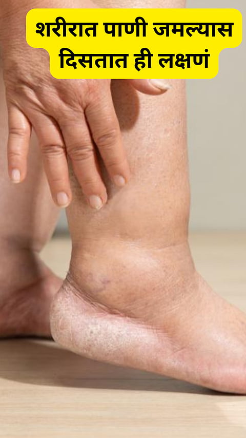 Fluid retention