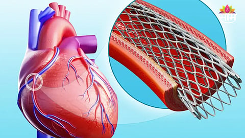 Heart blockage